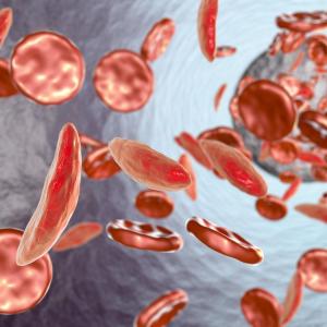 Hyponatraemia tied to worse outcome, acute chest syndrome in sickle cell disease patients