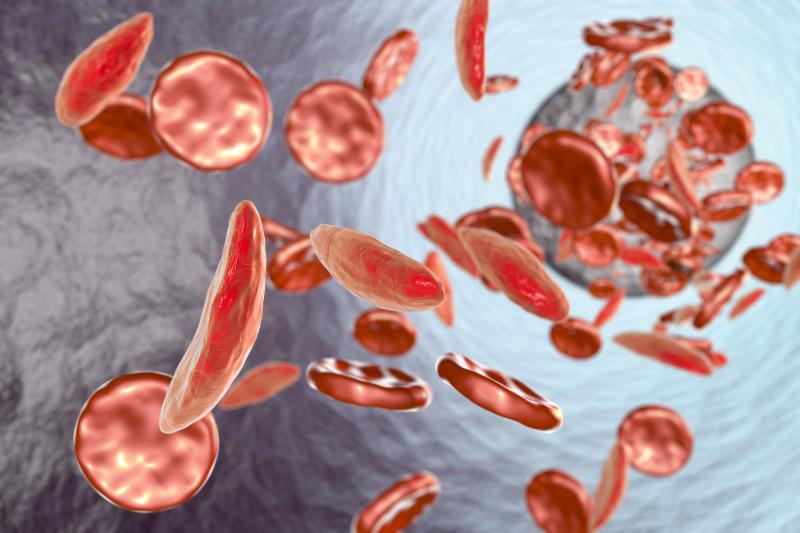 Hyponatraemia tied to worse outcome, acute chest syndrome in sickle cell disease patients