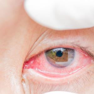 IOP-induced ONH strains negatively tied to retinal sensitivity in glaucoma patients