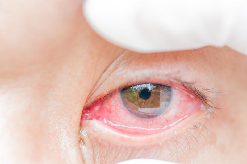 IOP-induced ONH strains negatively tied to retinal sensitivity in glaucoma patients