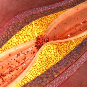 Carotid plaque presence, number linked to brachial-ankle pulse wave velocity