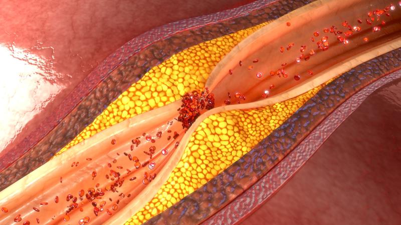 Carotid plaque presence, number linked to brachial-ankle pulse wave velocity