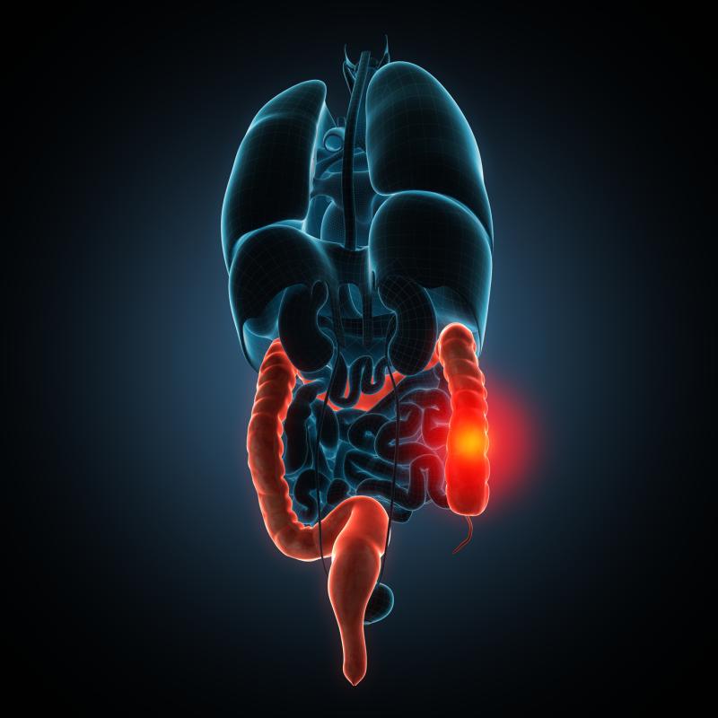 Medications, disease phenotype predict short bowel syndrome in Crohn’s disease