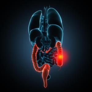 What is the optimal time interval between stent placement and surgery?