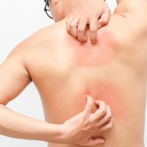 Poor lifestyle ups risk of incident psoriasis