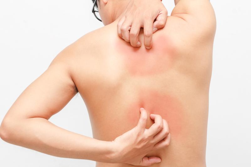 Poor lifestyle ups risk of incident psoriasis