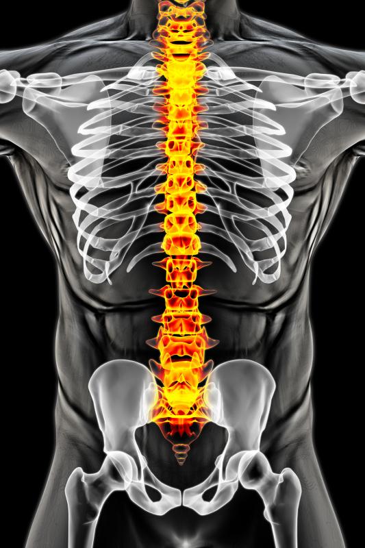 Radicular pain, weak extremities predict poor outcomes in lumbar disc herniation