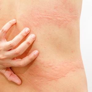 Promising treatment options for chronic hives on the horizon