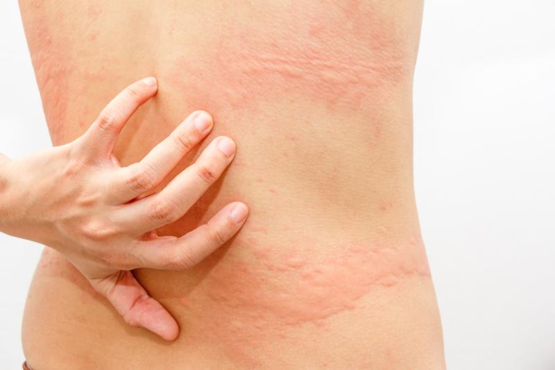 Lirentelimab shows promise in treatment-resistant chronic urticaria