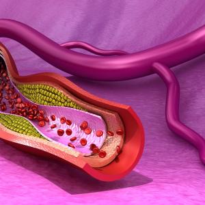 Major adverse limb events after peripheral artery revascularization linked to higher limb, cardiac risks