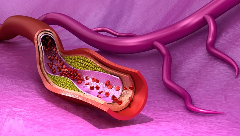 Major adverse limb events after peripheral artery revascularization linked to higher limb, cardiac risks