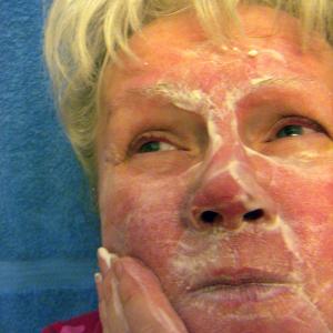 Modified glutathione cream effective in mild-to-moderate rosacea