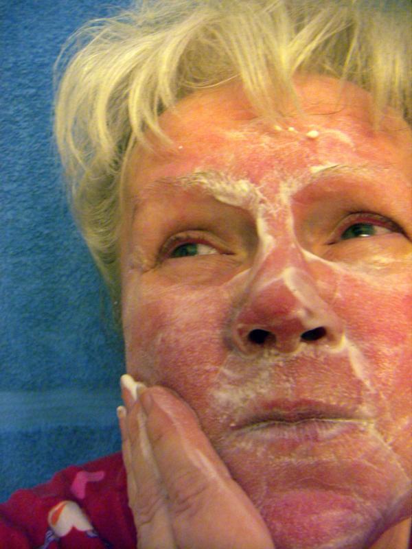 Modified glutathione cream effective in mild-to-moderate rosacea