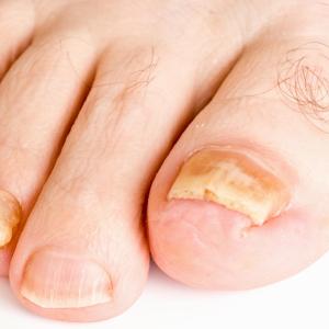 Topical terbinafine effective against mild-to-moderate onychomycosis