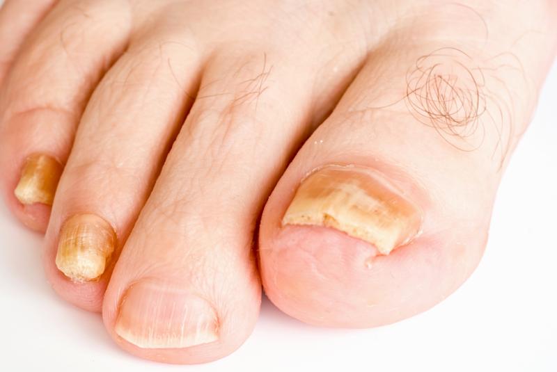 Topical terbinafine effective against mild-to-moderate onychomycosis