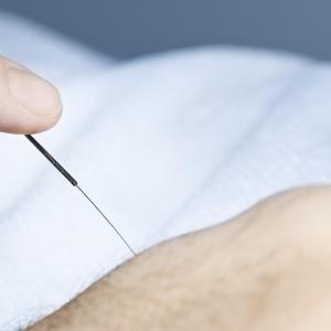 Electro-acupuncture delivers in knee osteoarthritis