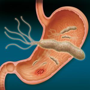 Vonoprazan-based triple therapy knocks out resistant H. pylori infection