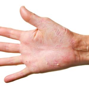 Brodalumab for psoriasis eases symptoms, ups treatment satisfaction