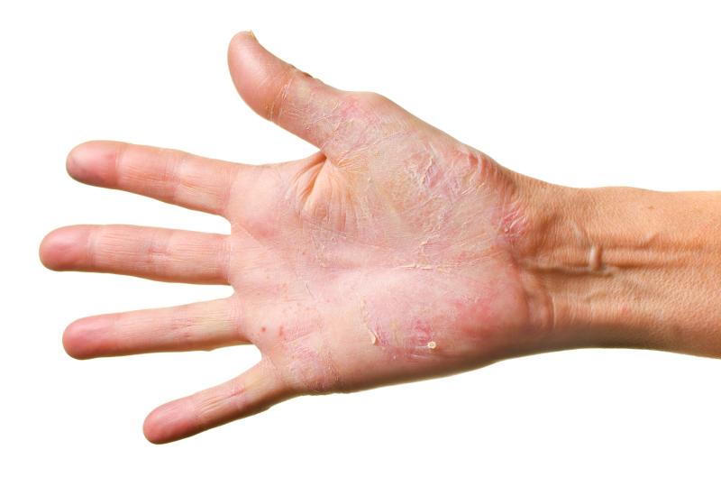 Brodalumab for psoriasis eases symptoms, ups treatment satisfaction