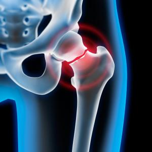 Diabetes increases the risk of fracture among patients on kidney replacement therapy