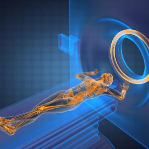 MRI- vs CT- guided radiotherapy for localized prostate cancer linked to lower toxicity, symptom burden