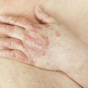 PF-06700841 shows therapeutic potential in moderate-to-severe plaque psoriasis