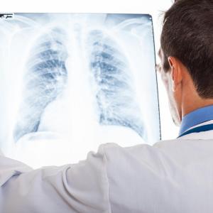 Nintedanib slows course of interstitial lung disease in Asians