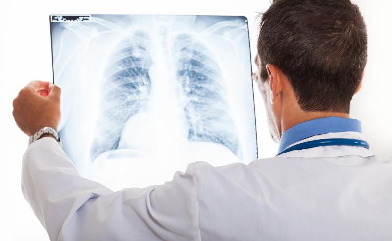 Nintedanib slows course of interstitial lung disease in Asians