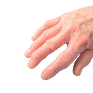 Hand OA tied to poorer physical, but not mental, quality of life