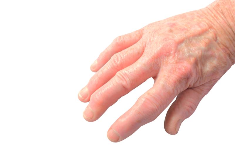 Hand OA tied to poorer physical, but not mental, quality of life