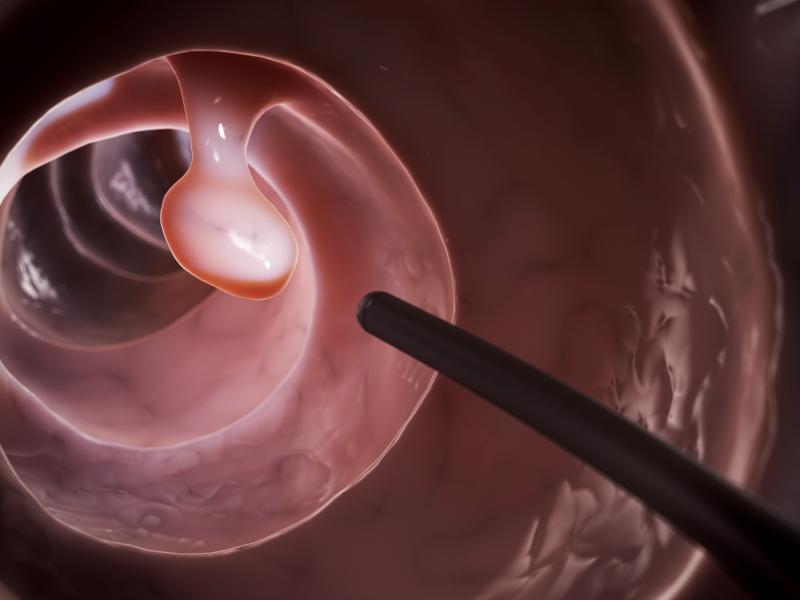 Incomplete resection predicts recurrence of colorectal neoplastic polyps