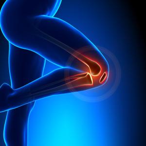 Bisphosphonates pose risk of atypical femur fracture