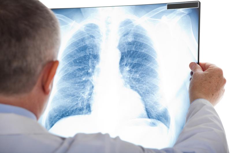 Tezepelumab improves lung function in severe asthma