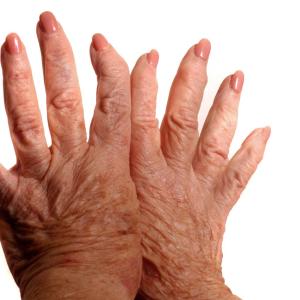 Index-to-ring finger ratio may identify older adults prone to TMCJ osteoarthritis