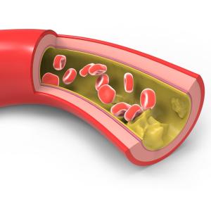 Low LDL-C tied to better cardiovascular outlook in diabetics