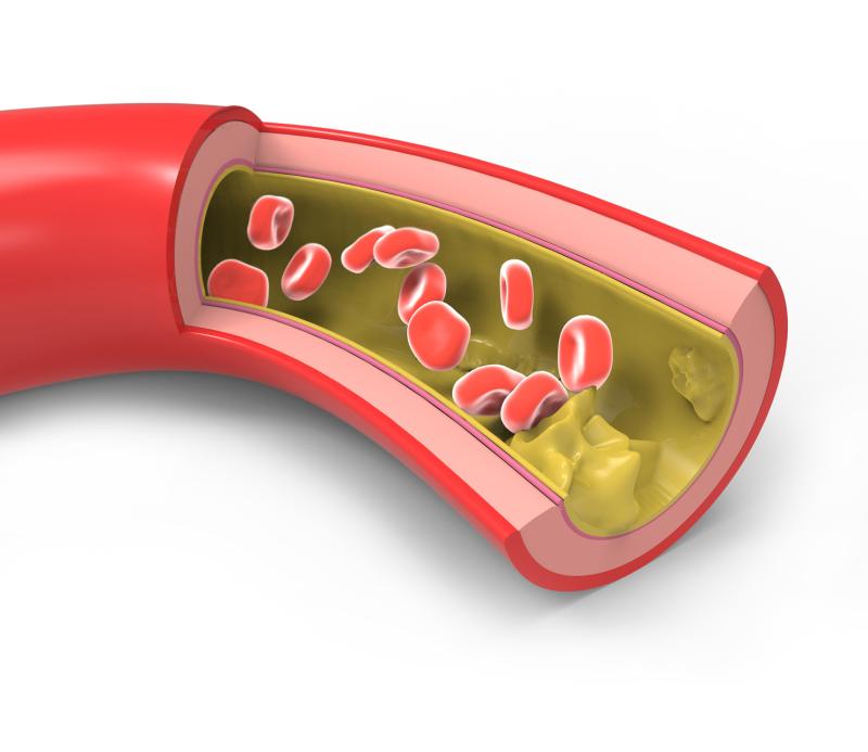 Low LDL-C tied to better cardiovascular outlook in diabetics