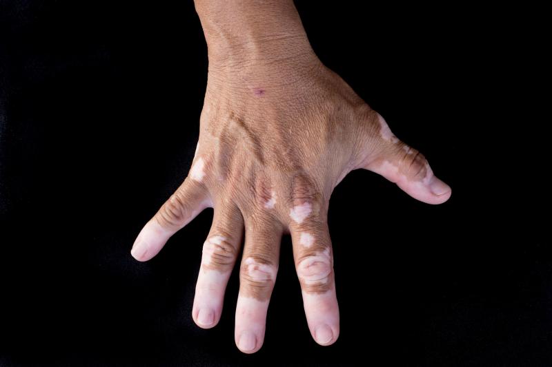 Individuals with vitiligo less prone to melanoma, skin cancer