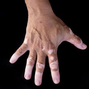 Shared medical appointments successful for vitiligo patients