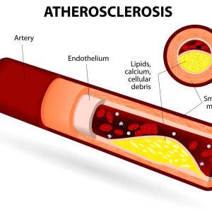 Increased plasma aldosterone concentrations up risk of atherosclerosis