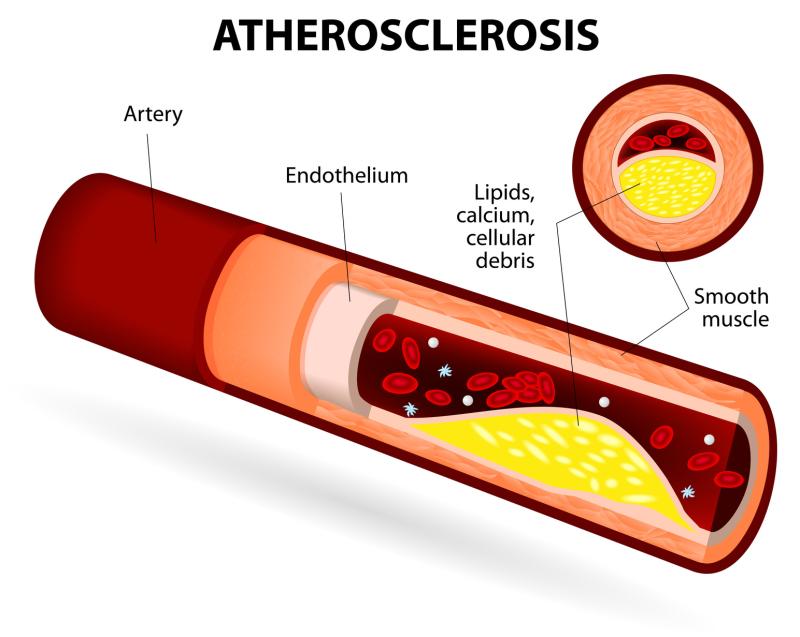 Increased plasma aldosterone concentrations up risk of atherosclerosis