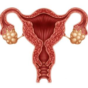 Immunosuppression treatment with mTORi carries risk of ovarian cyst