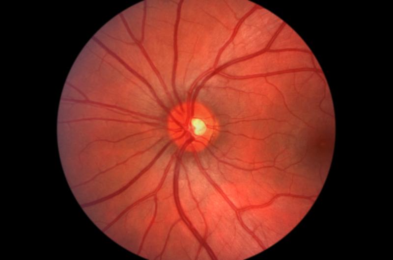 Adding fundus photography to eye clinics leads to more referrals