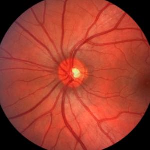 Adding fundus photography to eye clinics leads to more referrals