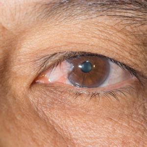 Rose Bengal PDAT a promising adjunct therapy for infectious keratitis