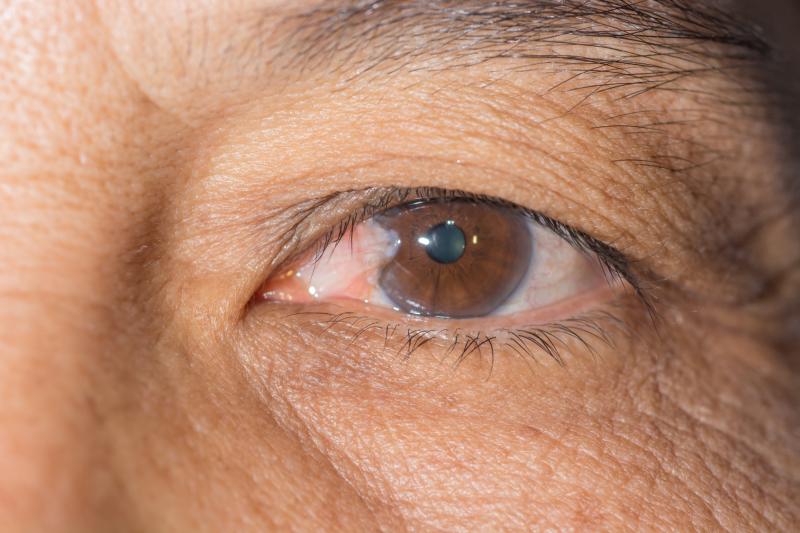 Photoreceptor thinning linked to genetic AMD susceptibility in Asians