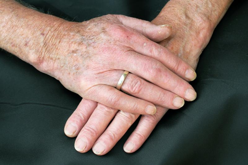 Secukinumab infusion shows therapeutic potential in psoriatic arthritis