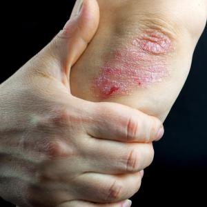 Discontinuation of inciting agent helps resolve TNFI-induced psoriasis