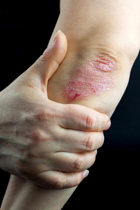 Discontinuation of inciting agent helps resolve TNFI-induced psoriasis