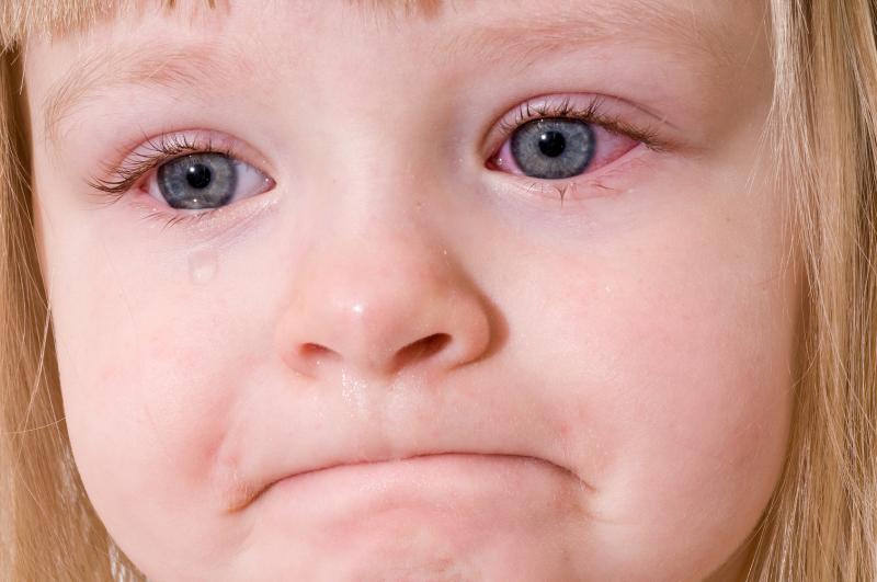 Topical antibiotics work well against acute infectious conjunctivitis in children