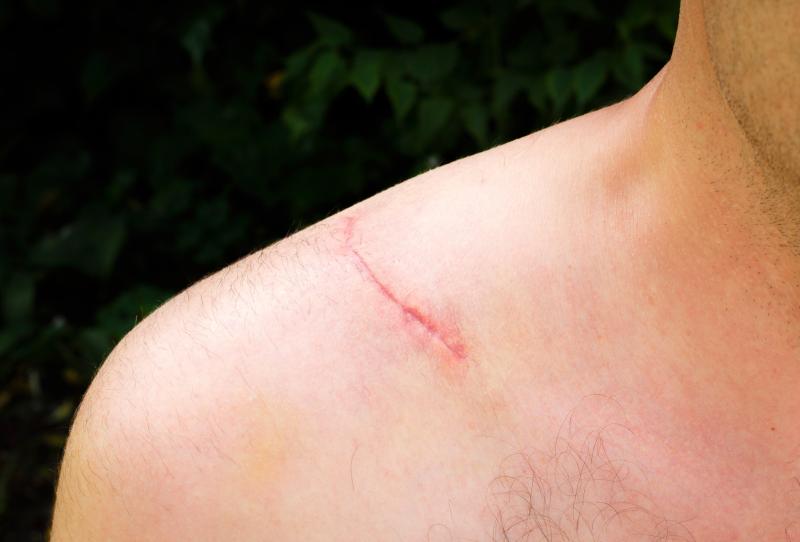 Serious adverse events rare after arthroscopic shoulder surgery, but snags do occur